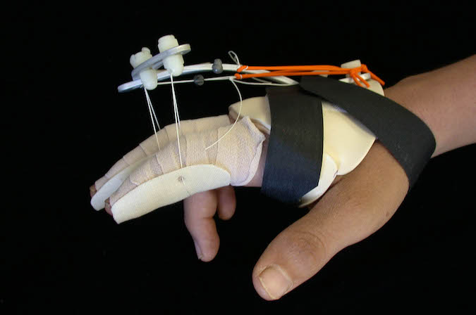 To facilitate independent tendon glide, prescribed exercises mobilize EDM and EIP separately from EDC. Multiple finger involvement requires fabrication of an elastic tension extension orthosis (reverse Kleinert). Image 7 and 8 contributed by Karen S Schultz MS OTR CHT