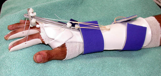 To facilitate independent tendon glide, prescribed exercises mobilize EDM and EIP separately from EDC. Multiple finger involvement requires fabrication of an elastic tension extension orthosis (reverse Kleinert). Image 7 and 8 contributed by Karen S Schultz MS OTR CHT