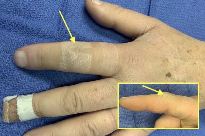 Note swollen index PIP joint (arrows) secondary to PIP sprain