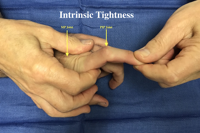 This patient has a intrinsic contracture. When the MP join is extended the PIP joint can not flexion normally.