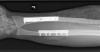 AP X-ray right distal -third transverse radius and ulna fractures after ORIF.