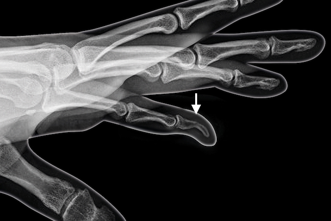 Kirner's Deformity left fifth finger