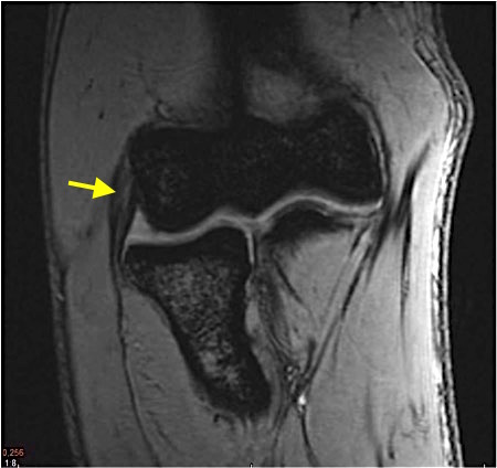 Lateral epicondylitis with intrasubstance degenerative tearing the ECRB.