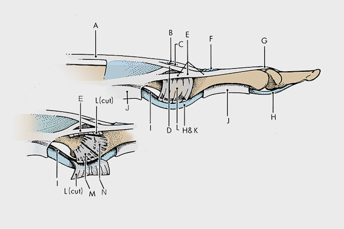 Finger extensor tendon anatomy lateral view:  A. Extensor tendon; B. Central slip; C. Oblique fibers of dorsal aponeurosis; D. Lateral slip; E. Conjoined lateral band; F. Triangular ligament; G. Terminal extensor tendon; H. Flexor digitorum profundus; I. Volar plate; J. A-2 & A-4 pulleys; K. Flexor digitorum superficialis; L. Transverse retinaculum; M. Accessory collateral ligament; N. Proper collateral ligament