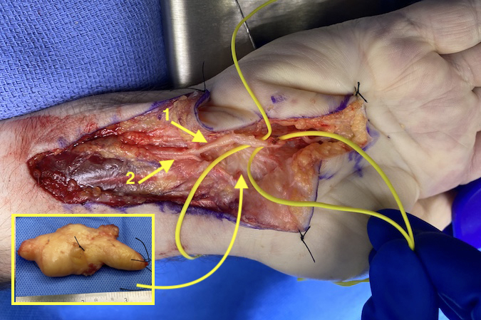 LIPOMA | Hand Surgery Resource