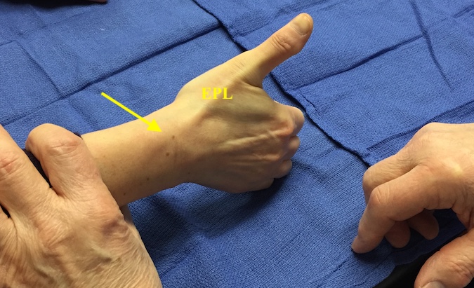 The EPL tendon travels in the third extensor compartment.  Lister's tubercle (arrow) acts as a fulcrum as the EPL changes direction.  In this tight part of third compartment tenderness can occur secondary to tendonitis, trauma etc.