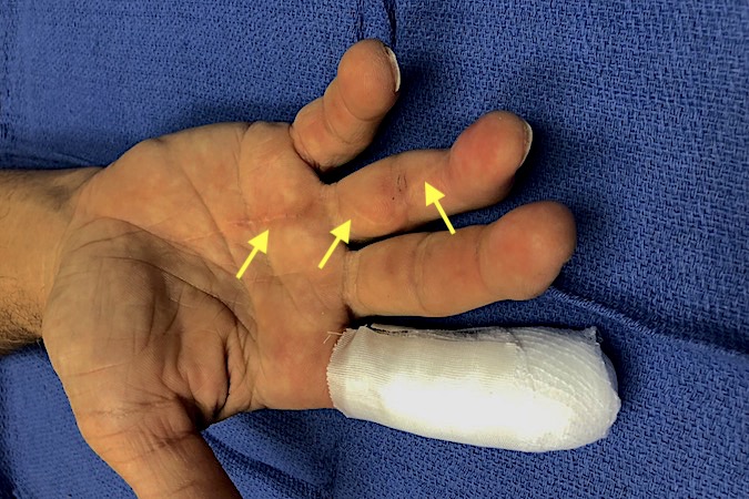 Lumbrical Plus Finger: Patient presents for simple index laceration who had serious injury to III,IV&V several years ago that require  tendon don graft (IV). Note old incisions (arrows). Now patient complains ring straightens while he tries to flex the ring finger.