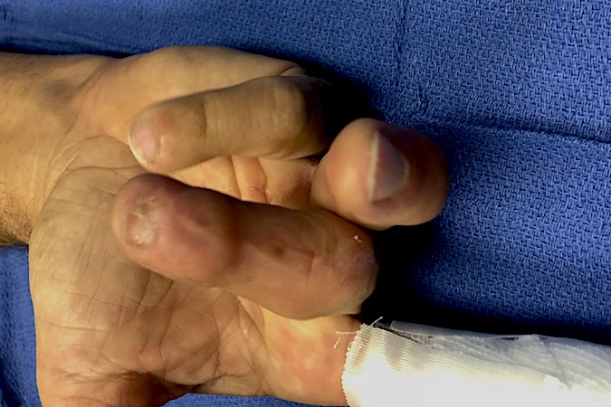 Lumbrical Plus Finger : Patient presents for simple index laceration who had serious injury to III,IV&V several years ago that required  tendon graft (IV).  Now patient complains ring straightens when he tries to flex it.