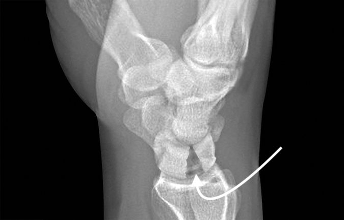 LUNATE FRACTURE | Hand Surgery Resource