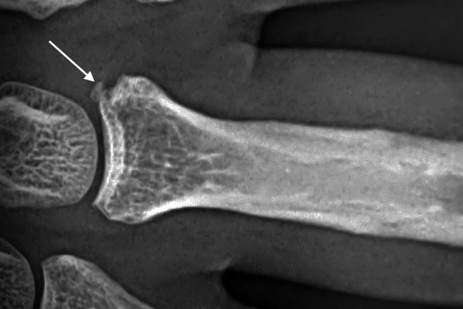 Left long finger MP joint sprain with UCL avulsion fracture (arrow). Expect fracture to heal with scar not bone.