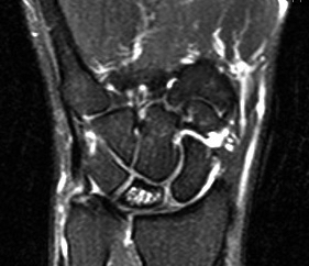 MRI Wrist 2 Kienbock's Disease