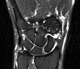 MRI Wrist T2