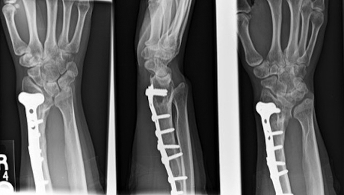 Right osteoplasties initially stabilized with K-wires, closing wedge bone used to graft opening distal wedge, and final stabilization done with T-plate and a stacked AO plate to increase plate length proximally.