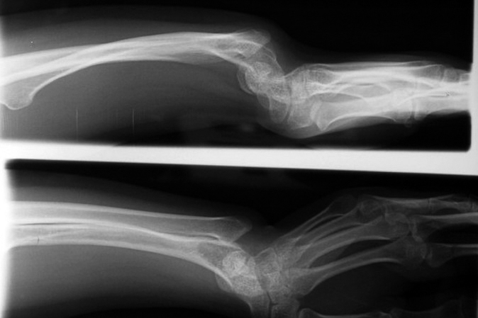 Left Madelung's deformity X-ray