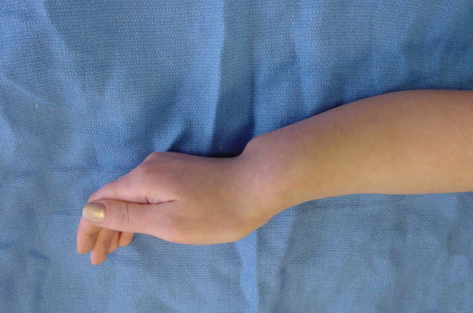 Madelung's deformity right upper extremity