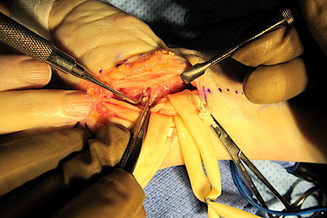 Floor of carpal tunnel with probe on volar carpal bone osteophyte that caused the attritional ruptures. Adjacent clamp on volar wrist capsule.