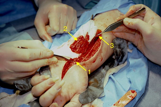 Neurofibromatous Hemangiomatous Hamartoma of the left median nerve has been excised after determining that there were no salvageable fascicular groups.  Distal median never (1); excised tumor (2) & proximal median nerve (3).  The median nerve gap was treated with sural nerve grafts.