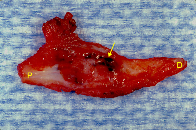 Neurofibromatous Hemangiomatous Hamartoma of the left median nerve excised with proximal end (P) and distal end (D).  Noted hemangiomatous changes (arrow).