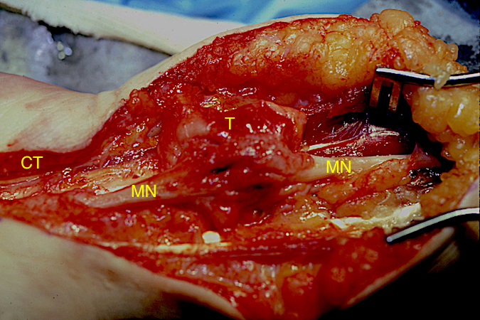 Neurofibromatous Hemangiomatous Hamartoma of the left median nerve in a 16 yo. female who presented with a mass in the left distal forearm.  Her complaints included painful paresthesias, hand numbness and weak pinch.  MRI showed a mass in the median nerve.  At surgery the carpal tunnel (CT) and distal forearm were exposed and a large tumor (T) of the median nerve (MN) was identified