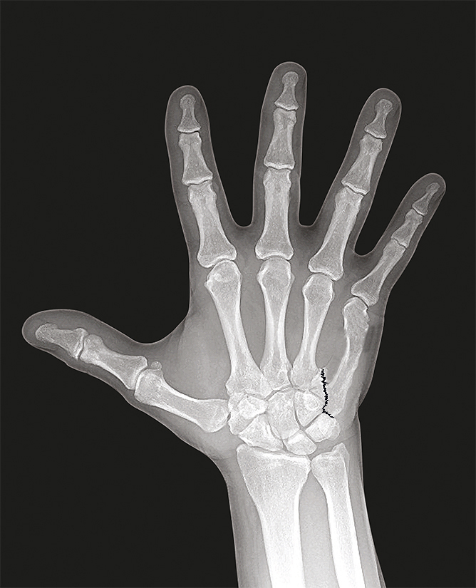 Fifth metacarpal displaced intra-articular fracture (AP)