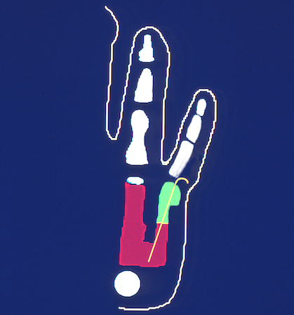 Ring-Little Partial Metacarpal Synostosis after lengthening and ulnarization osteotomy.