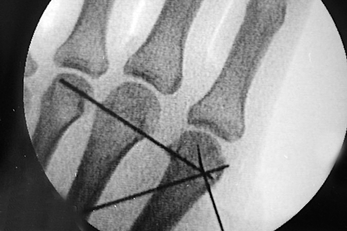 Pinning of metacarpal head fracture. Note potential for AVN of metacarpal head fracture fragments.