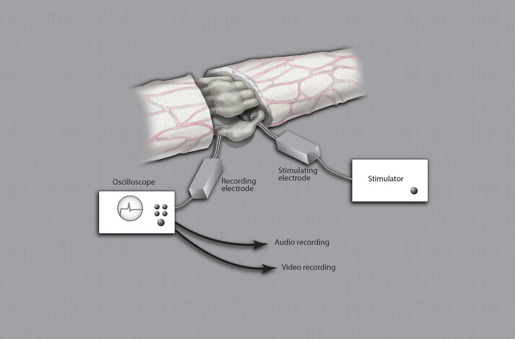 Ulnar nerve neuroma-in-continuity being evaluated by intra-operative electrophysiological testing.