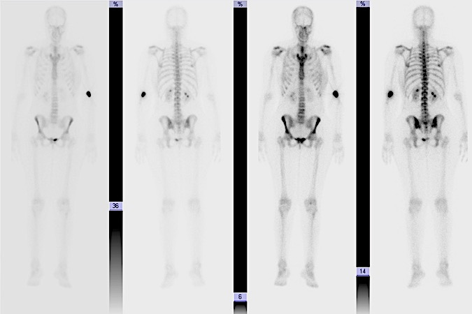 Normal bone scan showing focal uptake in the left antecubital fossa, the site of the intravenous injection.  Also note the physiological excretion of radiotracer by the kidneys as demonstrated by accumulation of radiotracer in the renal pelvis.