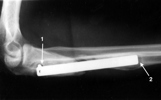 Osteomyelitis after ORIF of open ulna fracture.  Note loose screw (1) and osteolysis (2).