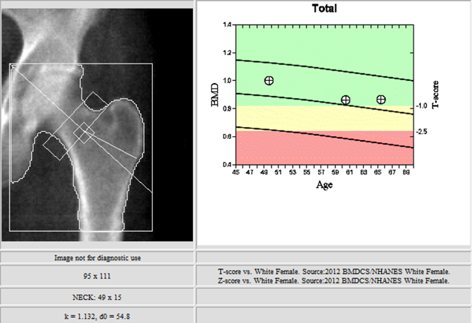 DXA Scan within the range of normal. Bone mineral density is usually calculated from the lumbar spine and femoral neck as demonstrated.