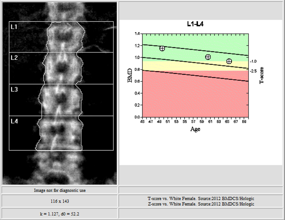 Radiology Studies - Dexa Scan | Hand Surgery Resource