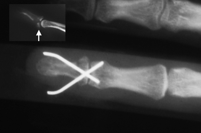 Distal phalanx Volar Plate Avulsion Fracture post ORIF & pinning