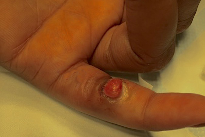 Pyogenic Granuloma left little finger before surgical excision.