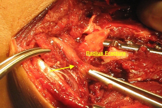 Another potential mechanical compression - radius fracture undergoing ORIF.  Note compression area on the PIN  (arrow).