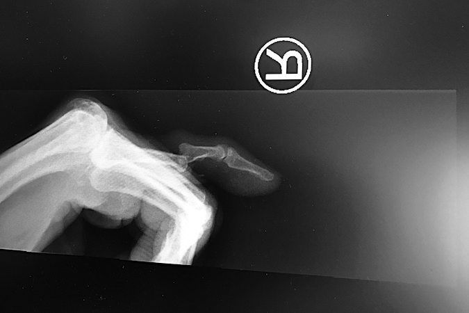 Dorsal lateral PIP dislocation