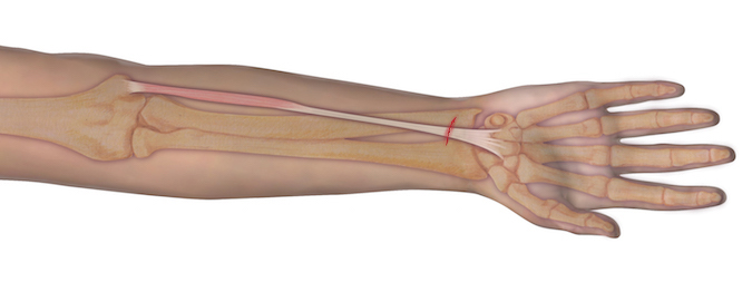 This illustration represents the anatomy of the muscle and tendon origin and insertion. Should an individual sustain a laceration as depicted, the observer can assume that the underlying tendon may be at risk for complete transection. A proper examination is needed to determine the integrity of the tendon.