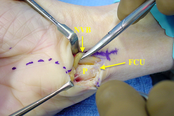 Excision of the pisiform for pisotriquetral osteoarthritis through the proximal part of an extended carpal tunnel incision. Pisiform (P); Neurovascular bundle (NVB); Flexor car ulnas (FCU) 