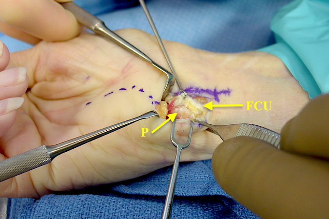 Excision of the pisiform. The FCU has been splitted and the attachments to the volar pisiform are being removed sharply. Pisiform (P); Flexor Carpi Ulnas (FCU)