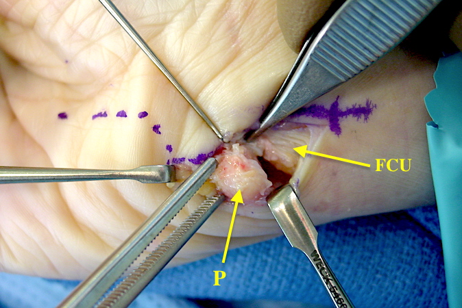 Excision of the pisiform. The pisotriqutral ligaments as the final step in pisiform excision.  Pisiform (P); Flexor Carpi Ulnaris (FCU)