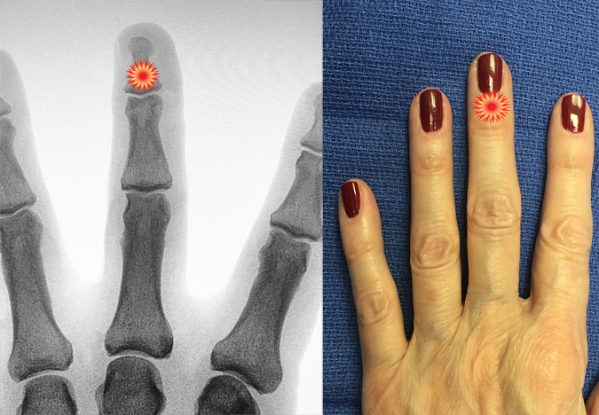 The red "tender" sign pin points the area of tenderness in relationship to the middle phalanx, distal phalanx, DIP joint and the surface anatomy of a patient with a paronychia.