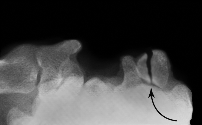 Displaced pisiform fracture (arrow)