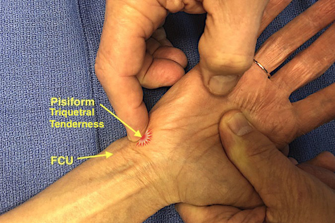 Examine the pisiform triquetral joint for tenderness.  FCU (flexor carpi ulnaris).