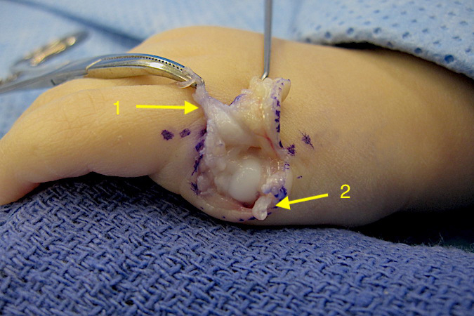 Left fifth finger polydactyly after volar approached used to identify and cut the digital arteries, digital nerves and flexor tendons. Extra digit now removed. Extensor to be attached to intact fifth extensor seen (1) and collateral (2) will be saved and used in reconstruction after partial metacarpal head remove by an osteotomy.