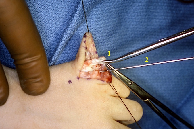 Left fifth finger polydactyly. Note collateral ligament (1) and K-wire (2) used to localize the osteotomy line.