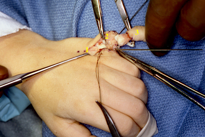 Left fifth finger polydactyly. Note extensor tendon (1), collateral ligament (2), and excised digit (3).