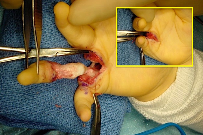 Right fifth finger polydactyly with radial partial ray in forceps now excised.  Insert shows potential appearance after repair or reconstruction of inter-metacarpal ligament.