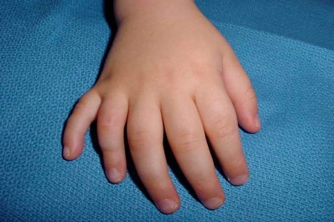 Polydactyly right hand with extra fifth finger.