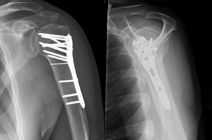 Completed ORIF of comminuted closed left proximal humerus fracture