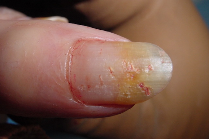 Finger Nail Pitting Secondary to Psoriasis.