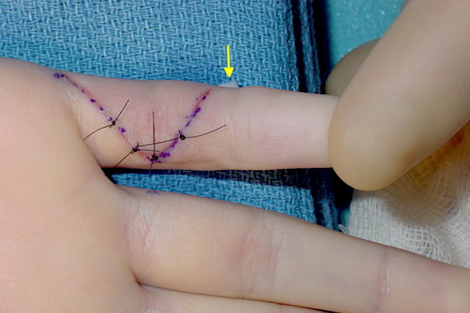  Volar plate rupture right fifth finger being repaired.  Note arrow on edge of pad under button over which suture was tied.